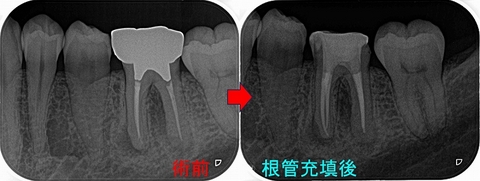 歯内療法日記: 2024年1月アーカイブ - EE DENTAL_Blog